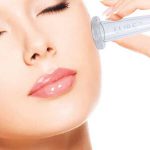 facial cupping en guadalajara | ideal para el acne